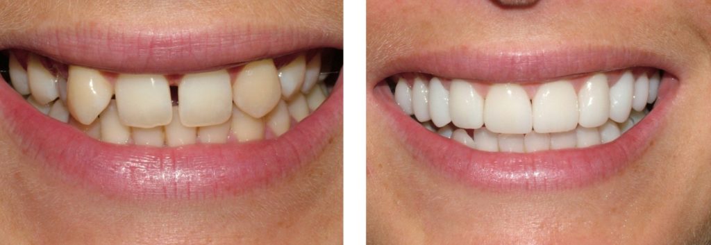 zoom teeth whitening porcelain veneers