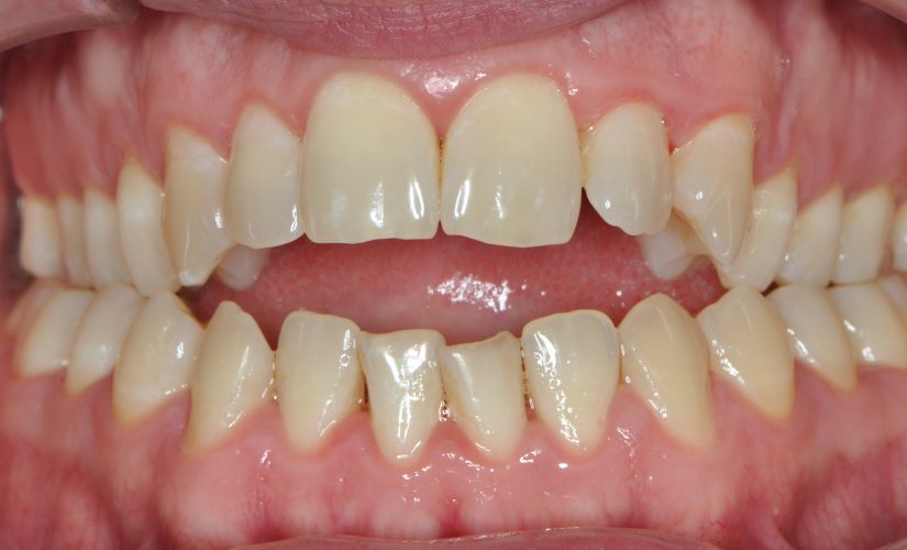 Stanje po končanem parodontalnem zdravljeneju z zdravo čvrsto dlesnijo